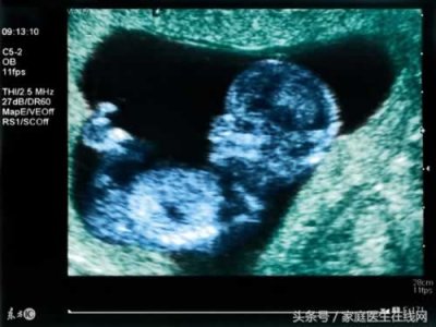 ​盆腔积液多少算正常 医生告诫：大于1公分要上医院了